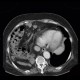 Morgagni hernia, diaphragmatic hernia, large, congenital: CT - Computed tomography